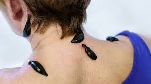 Kontroversi Terapi Lintah, Bermanfaat Atau Berbahaya?